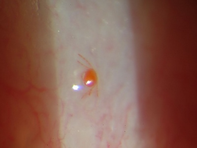 A photograph of a Neotrombicula autumnalis mite in contact with the left upper eyelid margin. The parasitic larvae of these mites are commonly known as Chiggers.